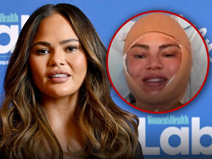 Chrissy Teigen Reveals Facial Surgical procedure Throughout Instagram Stay Stream