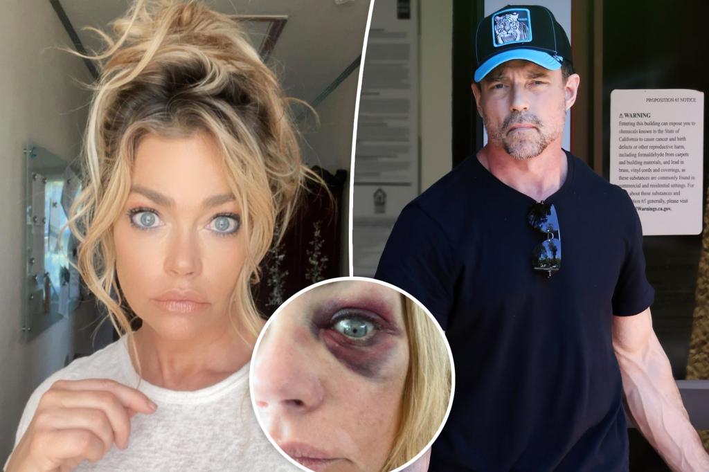 Aaron Phypers’ pal claims Denise Richards’ black eye was results of a drunken fall, not abuse