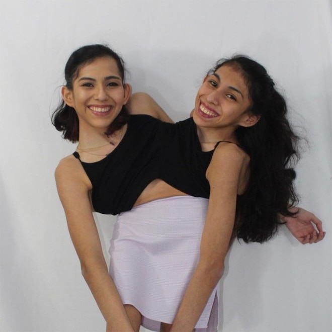 Conjoined Twin Carmen Andrade Shares Look Into Her Summer With Husband