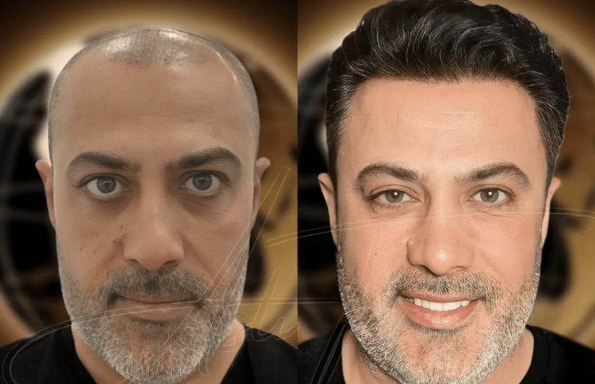 Top 10 Best Hair Transplant in Turkey: Expert Clinics