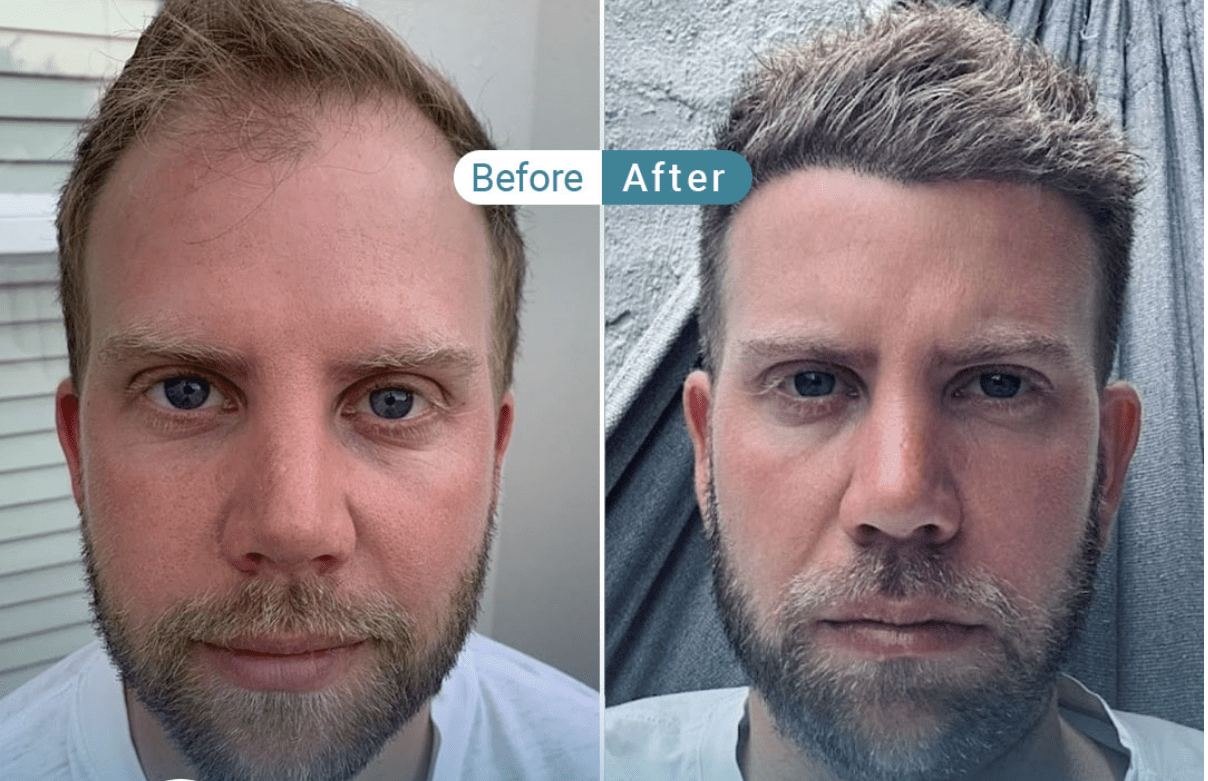 Top 10 Hair Transplant Clinics in Turkey – Reputable Clinics You Can Trust