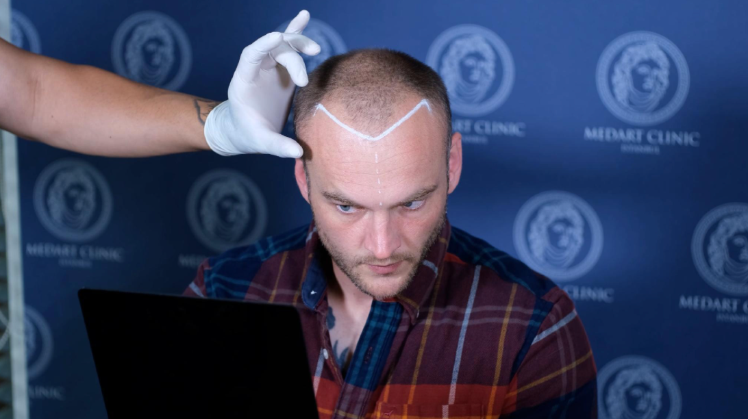 Top 5 Doctor-Led vs Top 5 High-Volume Hair Transplant Turkey Clinics for Complex Cases 2026