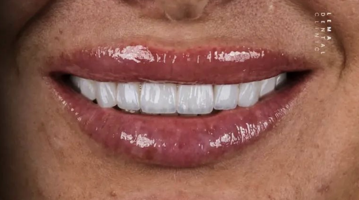Technique​‍​‌‍​‍‌​‍​‌‍​‍‌ Hollywood Smile 3D: How is Hollywood Smile Done?