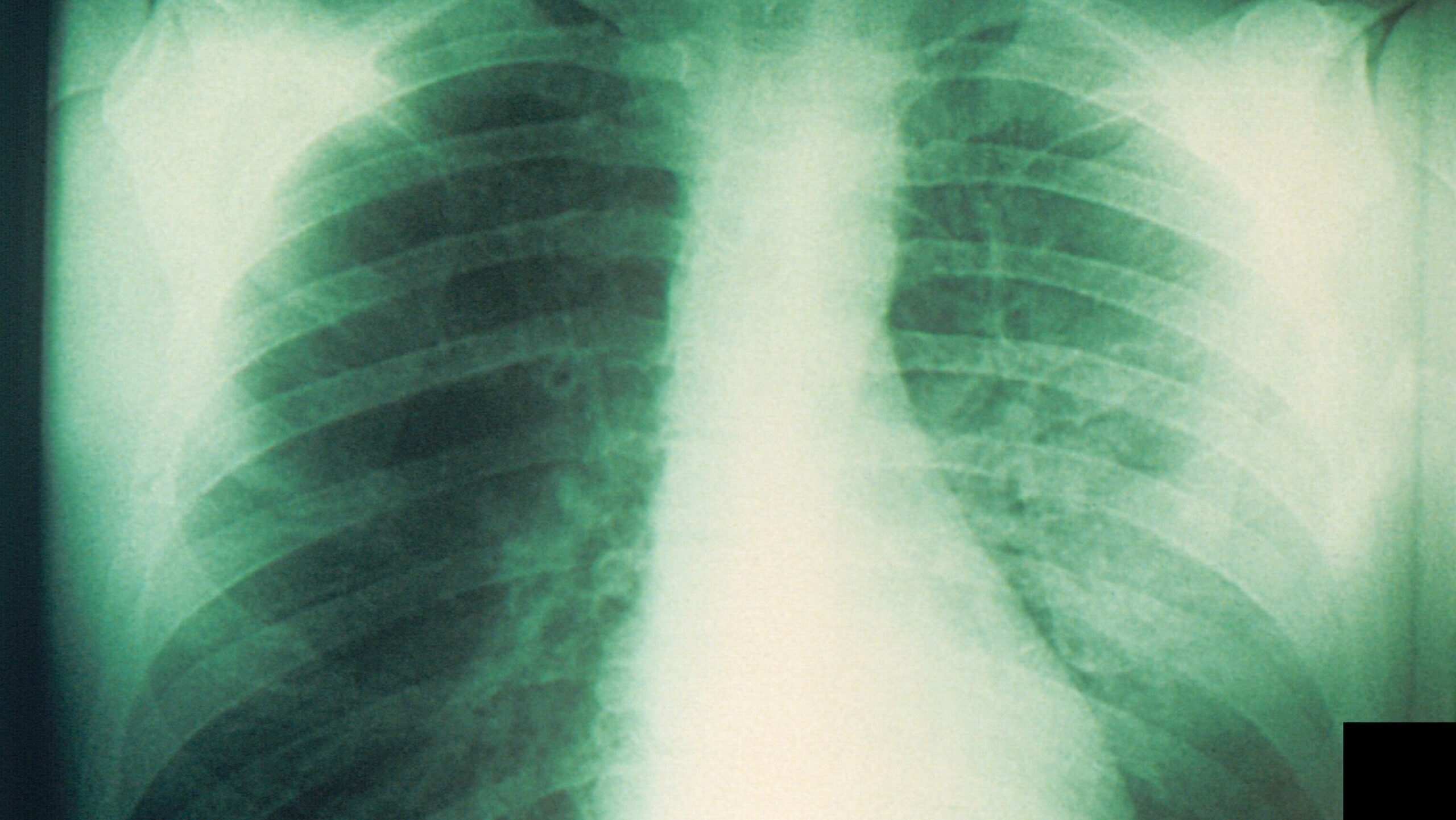 What Is Pneumonic Plague? Symptoms of the Lung Infection